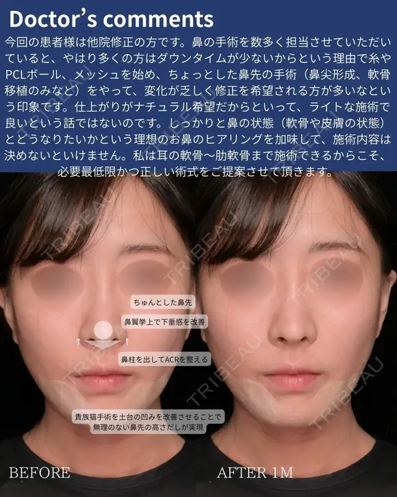 肋軟骨鼻フル 30日後 メイン用