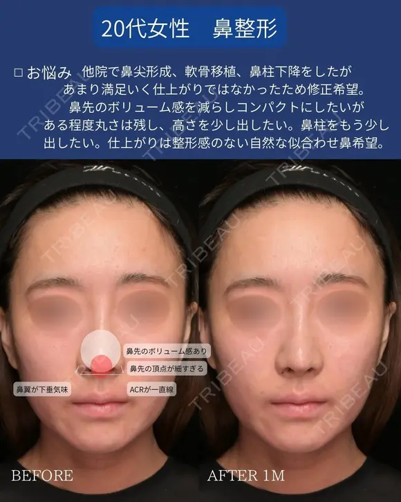 肋軟骨鼻フル 30日後 メイン用