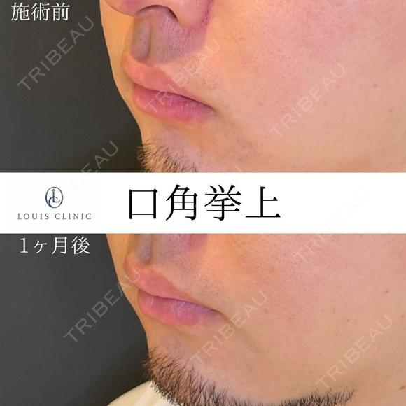 口角挙上 30日後 メイン用
