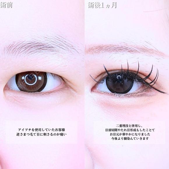 アリエルクイックループトリプル二重埋没法/まぶたの脂肪取り/目頭切開/タレ目形成 before画像 メイン用
