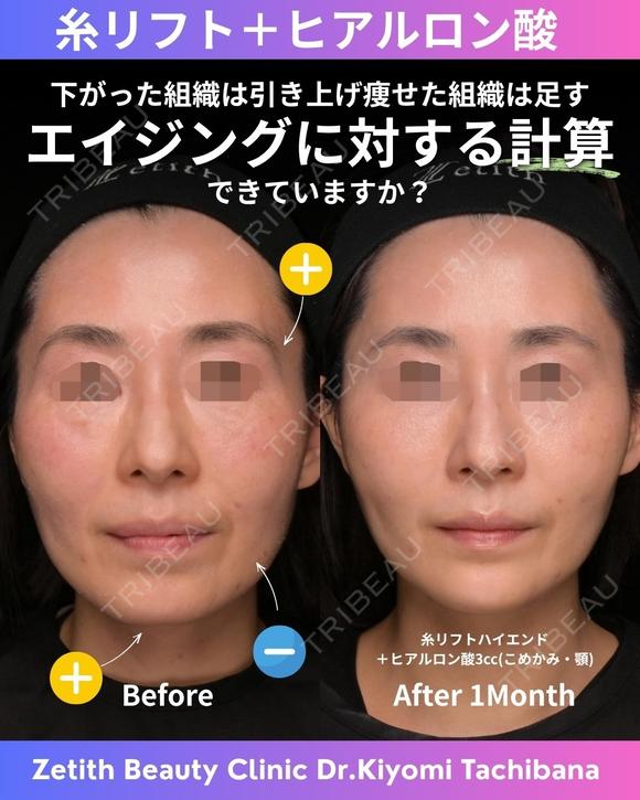糸リフト+ヒアルロン酸 30日後 メイン用