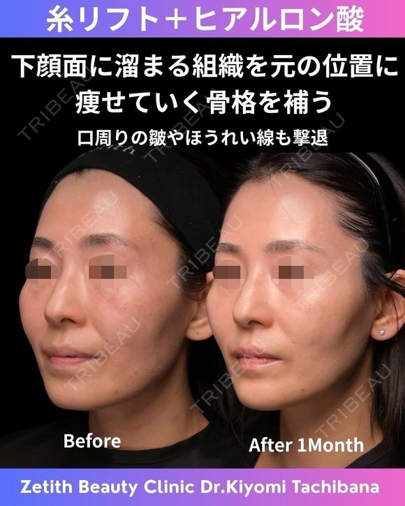 糸リフト+ヒアルロン酸 30日後 メイン用