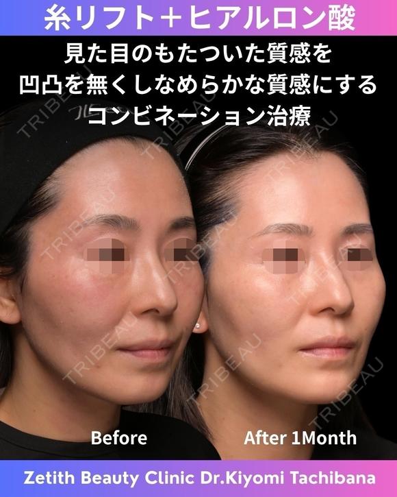 糸リフト+ヒアルロン酸 30日後 メイン用