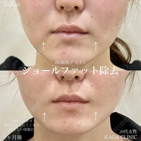 加賀デザイン×ジョールファット除去 before画像 メイン用