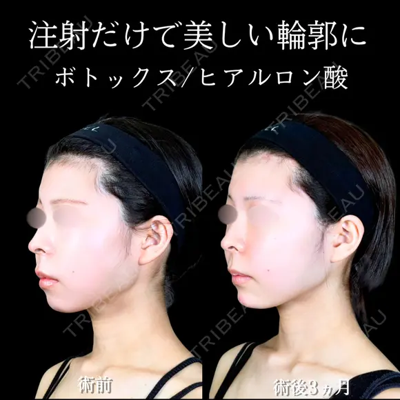 エラボトックス/顎ヒアルロン酸 90日後 メイン用