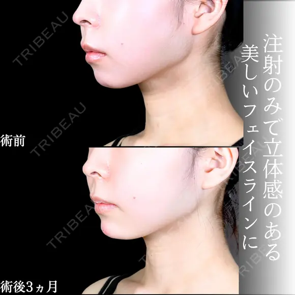 エラボトックス/顎ヒアルロン酸 before画像 メイン用
