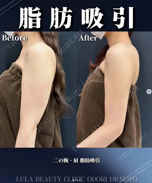 二の腕・肩脂肪吸引 after画像 メイン用