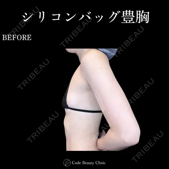 シリコンバッグ豊胸💎麻酔代込み before画像 メイン用