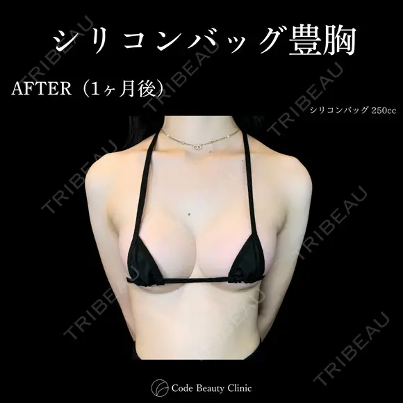 シリコンバッグ豊胸💎麻酔代込み 30日後 メイン用