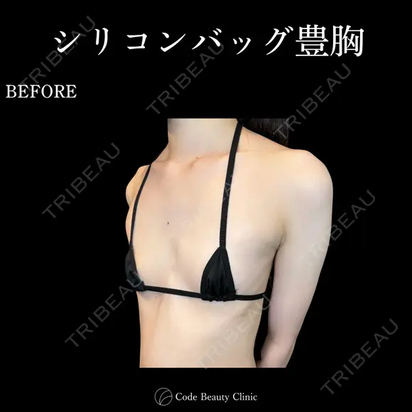 シリコンバッグ豊胸💎麻酔代込み before画像 メイン用