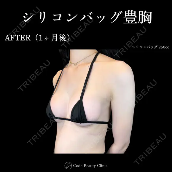シリコンバッグ豊胸💎麻酔代込み 30日後 メイン用