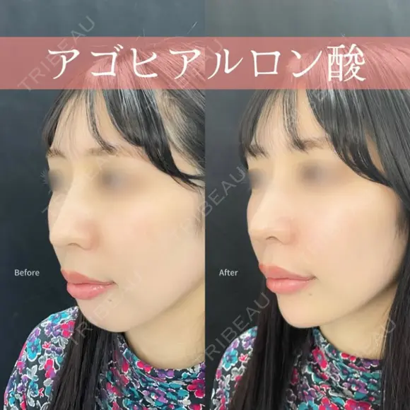 アゴヒアルロン酸 1日後 メイン用