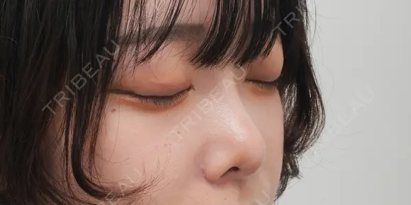 プロテーゼ隆鼻術・鼻尖形成（耳介軟骨移植）・鼻翼縮小 after画像 メイン用