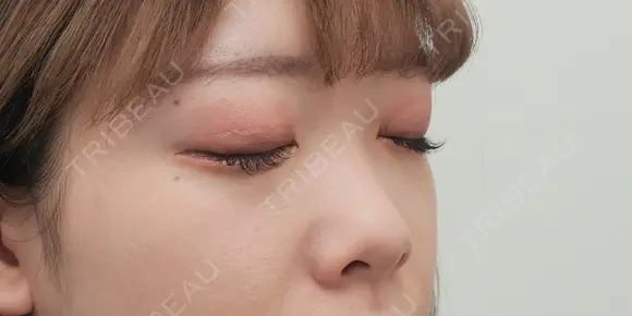 プロテーゼ隆鼻術・鼻尖形成（耳介軟骨移植）・鼻翼縮小 before画像 メイン用