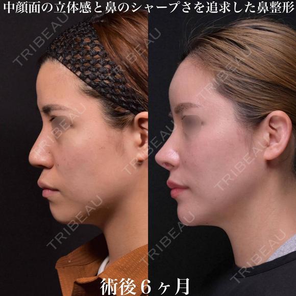 鼻整形 180日後 メイン用
