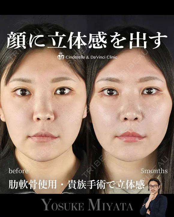 立体的な顔に 150日後 メイン用