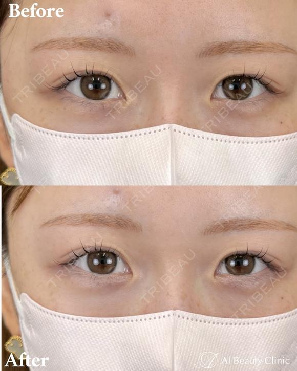 涙袋ヒアルロン酸 before画像 メイン用