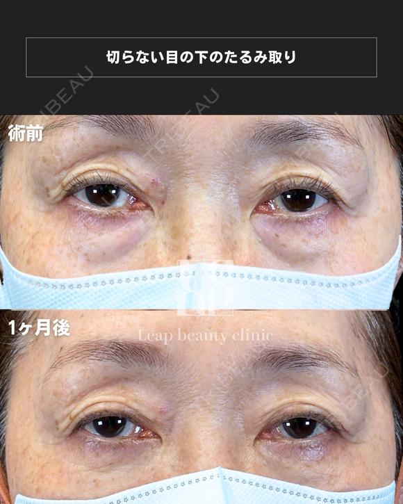 クマ取り（脱脂） after画像 メイン用
