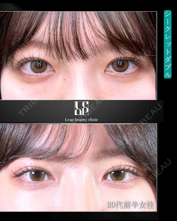 二重埋没｜シークレットダブル before画像 メイン用