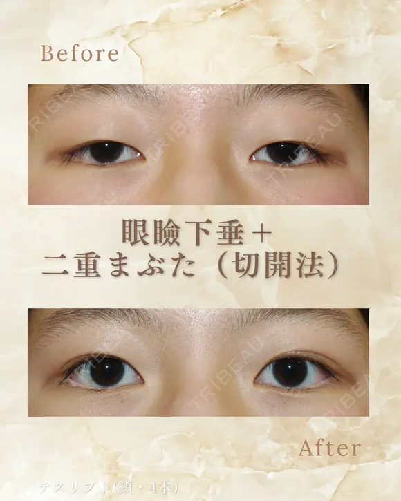 眼瞼下垂＋二重まぶた（切開法） before画像 メイン用