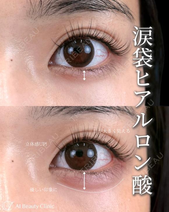 涙袋ヒアルロン酸 after画像 メイン用