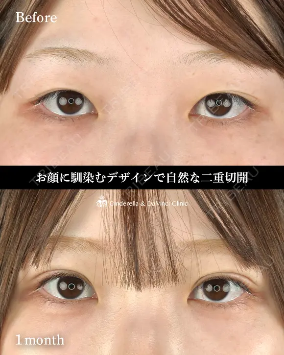 二重切開でミックス型 30日後 メイン用