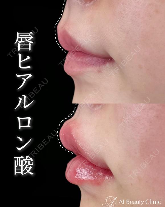 唇ヒアルロン酸 after画像 メイン用