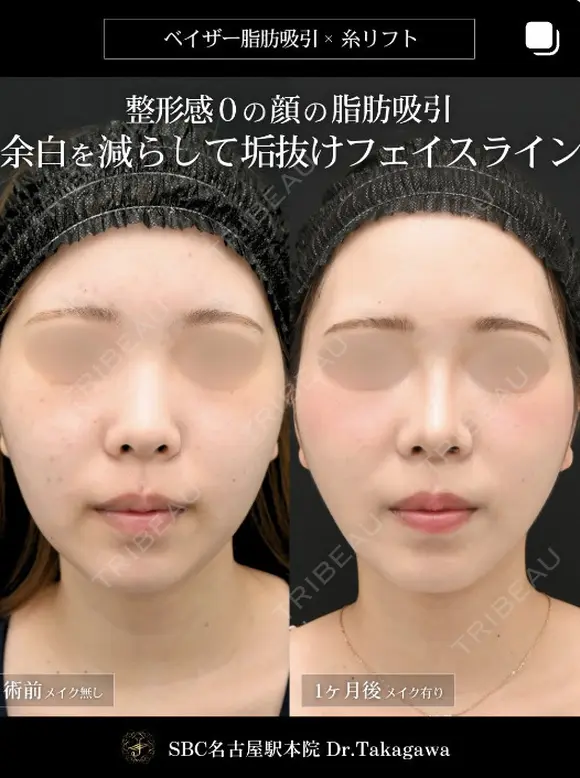 高川医師の脂肪吸引症例 before画像 メイン用