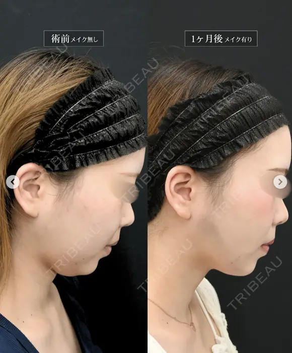 高川医師の脂肪吸引症例 after画像 メイン用