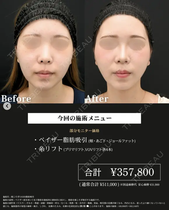 高川医師の脂肪吸引症例 after画像 メイン用
