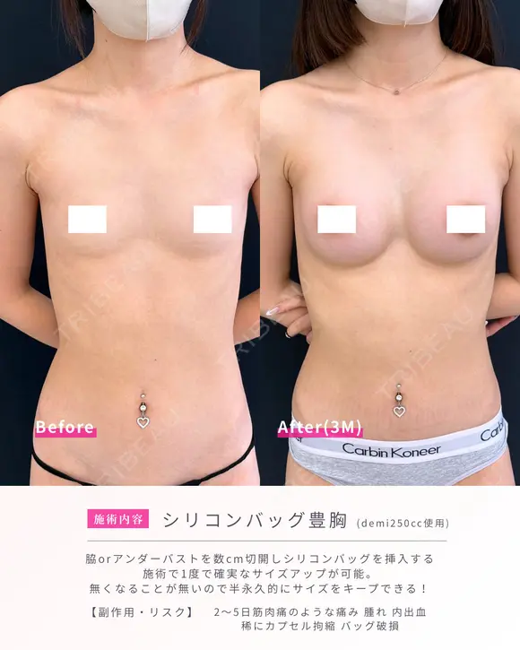 シリコンバック豊胸 before画像 メイン用