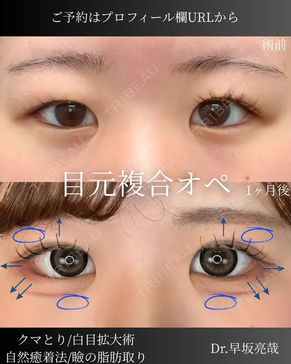 目元複合オペ（自然癒着法・まぶた脂肪取り・白目拡大術・目の下のふくらみ取り） before画像 メイン用
