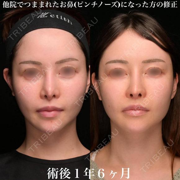 他院鼻修正 before画像 メイン用