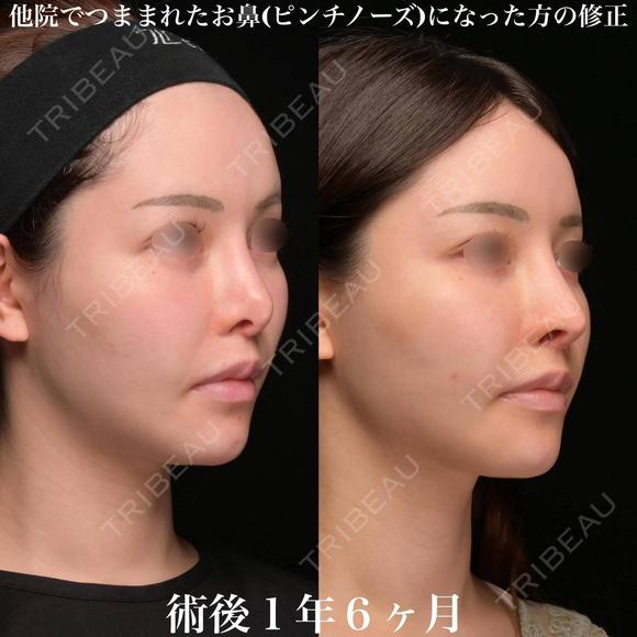 他院鼻修正 540日後 メイン用