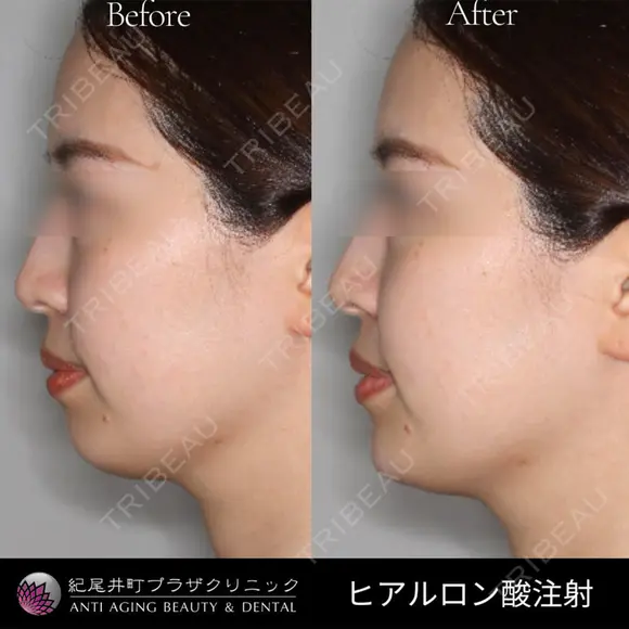 ヒアルロン酸注入（あごの輪郭を整える治療） before画像 メイン用