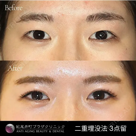 二重埋没法3点留 before画像 メイン用