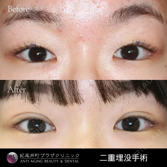 二重埋没法3点留 before画像 メイン用