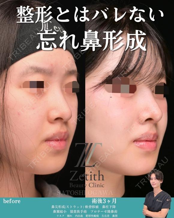 忘れ鼻形成 90日後 メイン用