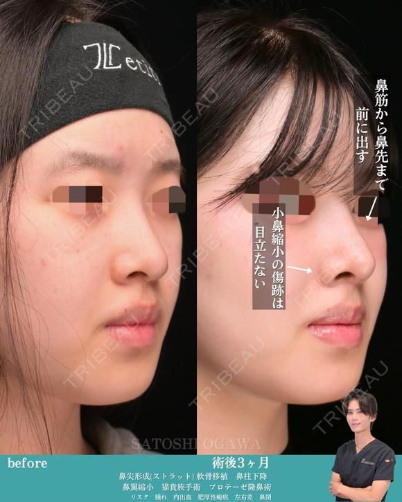 忘れ鼻形成 90日後 メイン用