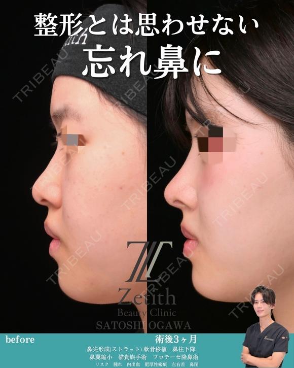 忘れ鼻形成 90日後 メイン用