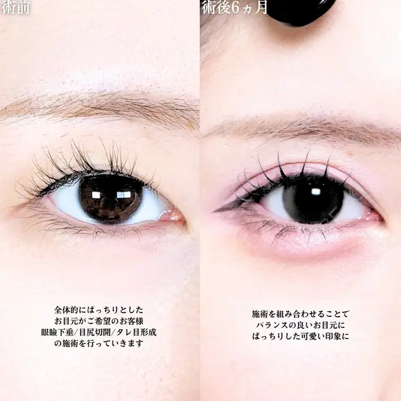 眼瞼下垂(たるみ取り併用)/目尻切開/タレ目形成術/皮膚切除 before画像 メイン用