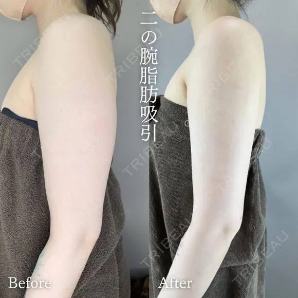 二の腕・肩 脂肪吸引 after画像 メイン用