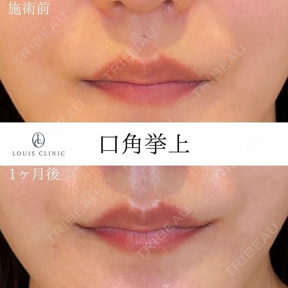 口角挙上 before画像 メイン用