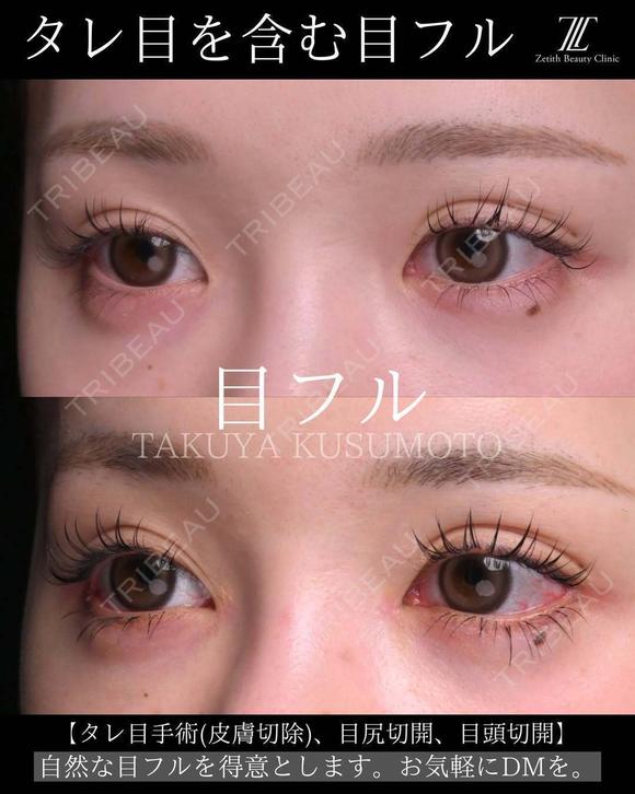 タレ目を含む目フル 30日後 メイン用