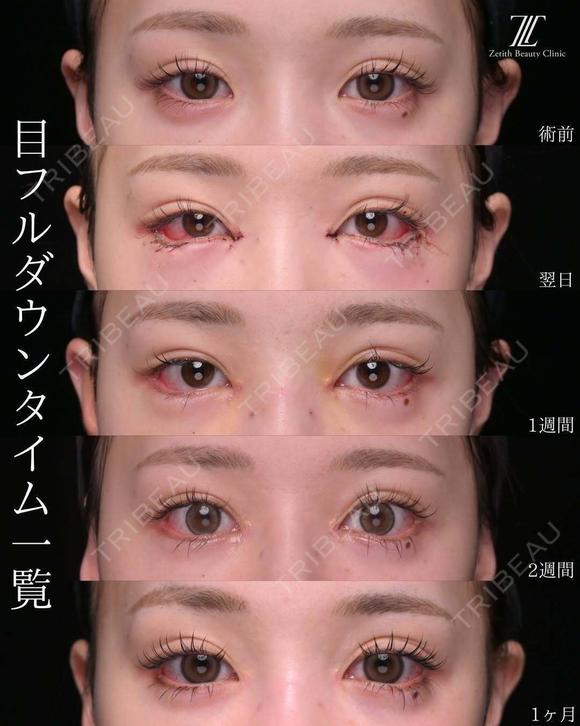 タレ目を含む目フル 30日後 メイン用