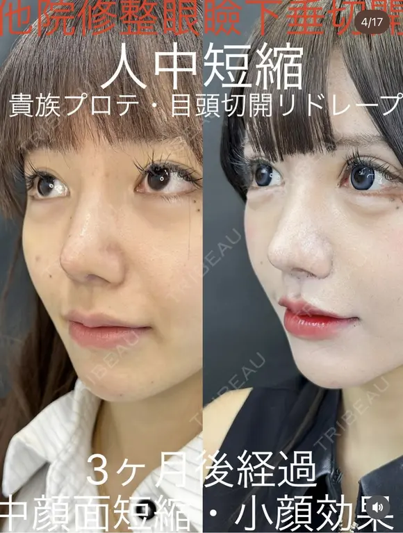 人中短縮　貴族プロテーゼ　眼瞼下垂　目頭切開 before画像 メイン用