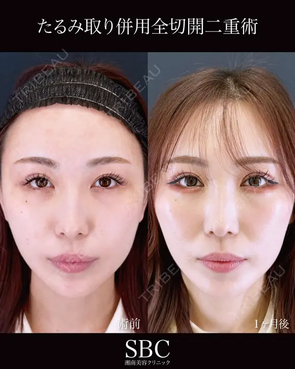 たるみ取り併用全切開二重術 after画像 メイン用