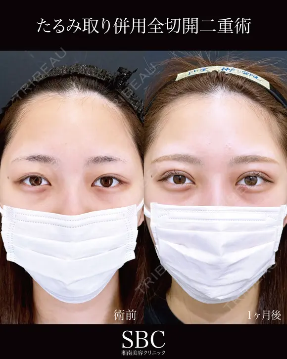 たるみ取り併用全切開二重術 before画像 メイン用