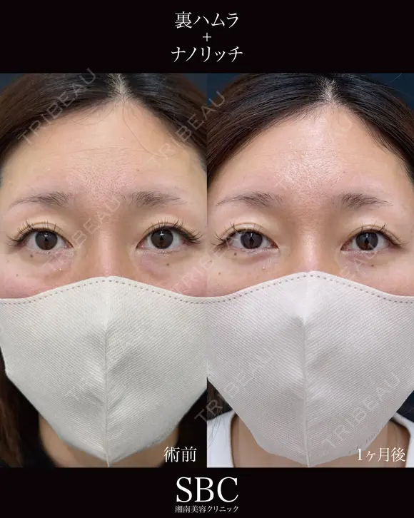 裏ハムラ・ナノリッチ before画像 メイン用