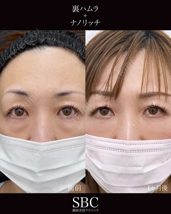 裏ハムラ・ナノリッチ after画像 メイン用